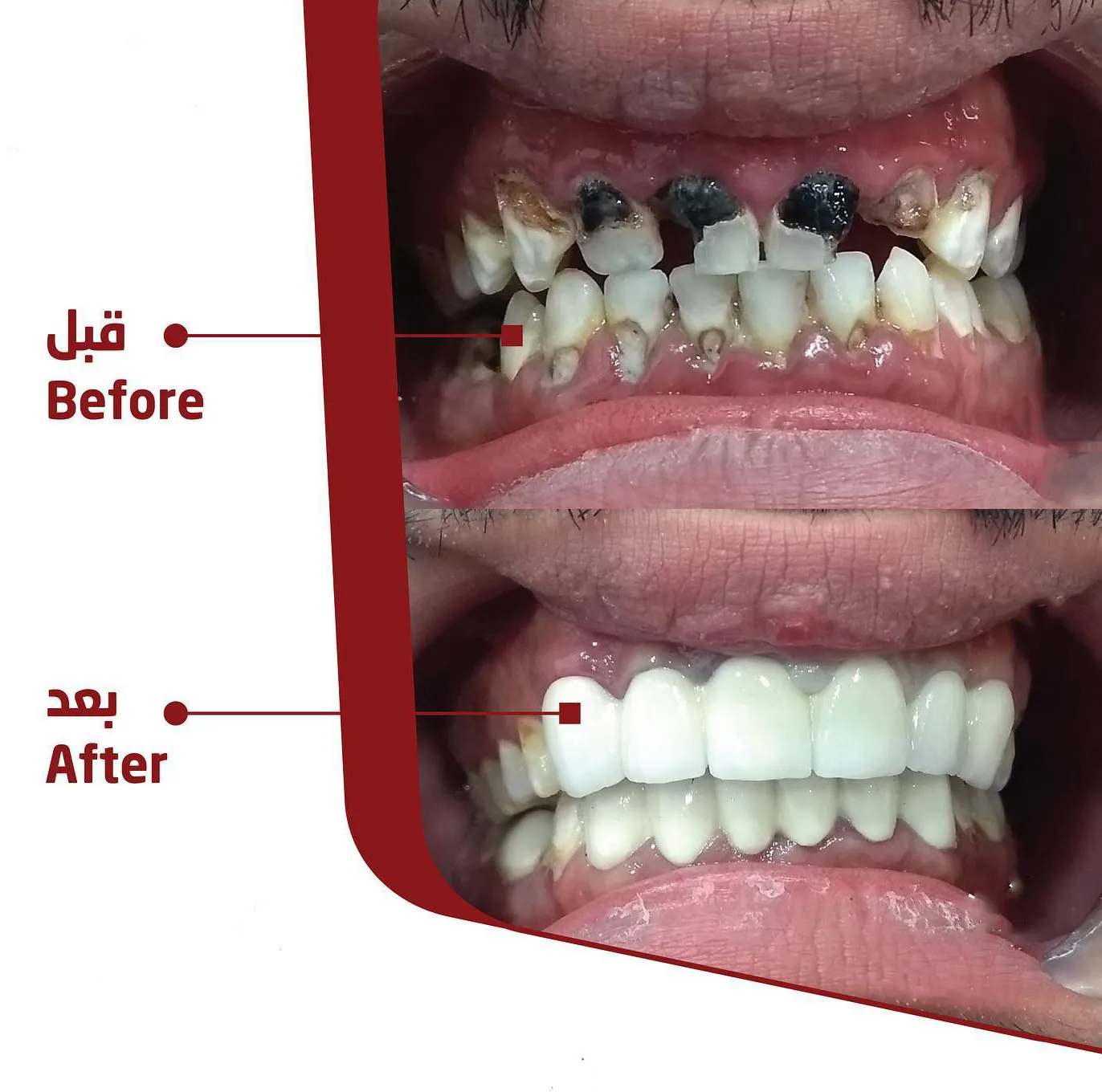 Complete Smile Restoration